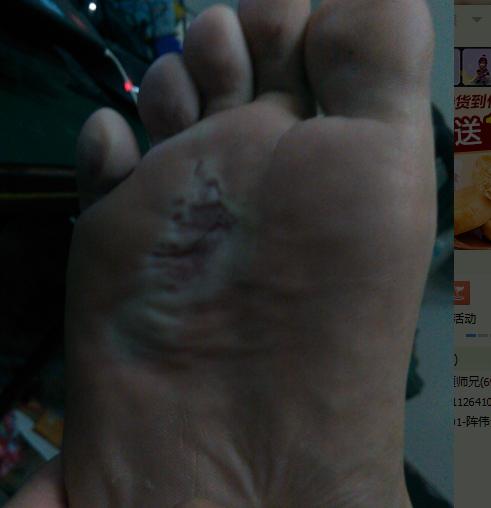 脚底长黑色<font color='red'>胎记</font>算命 右脚外侧有黑色<font color='red'>胎记</font>