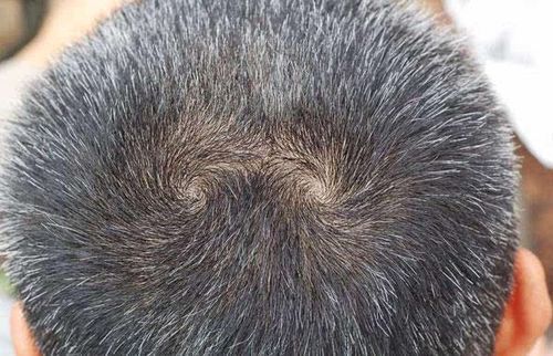 <font color='red'>头上</font>漩涡看相算命 <font color='red'>头上</font>的漩涡歪了