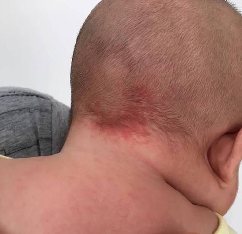 脖子<font color='red'>胎记</font>算命 脖子后有<font color='red'>胎记</font>算命