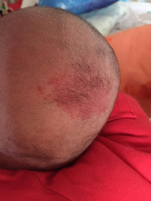 头顶有红色的胎记算命 算命说<font color='red'>命中</font>有暗胎记