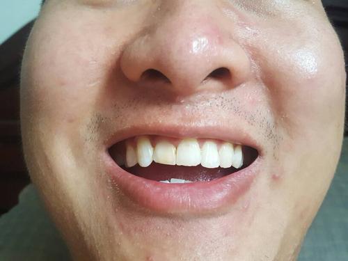 门牙歪了<font color='red'>一颗</font>的命运 门牙被旁边的牙挤歪了